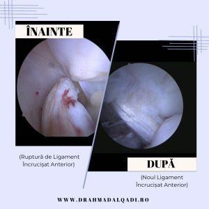 Ligamentoplastie / Reconstrucție ligamentară