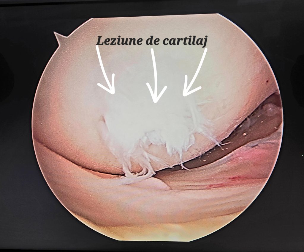Leziune de cartilaj