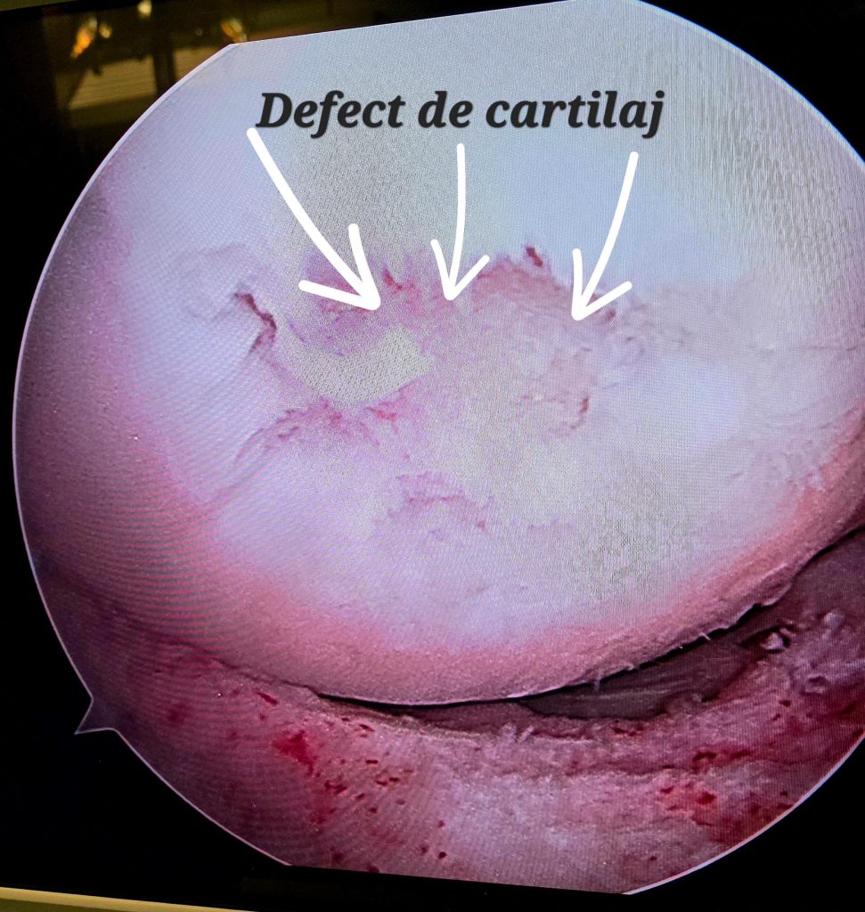 Leziune de cartilaj