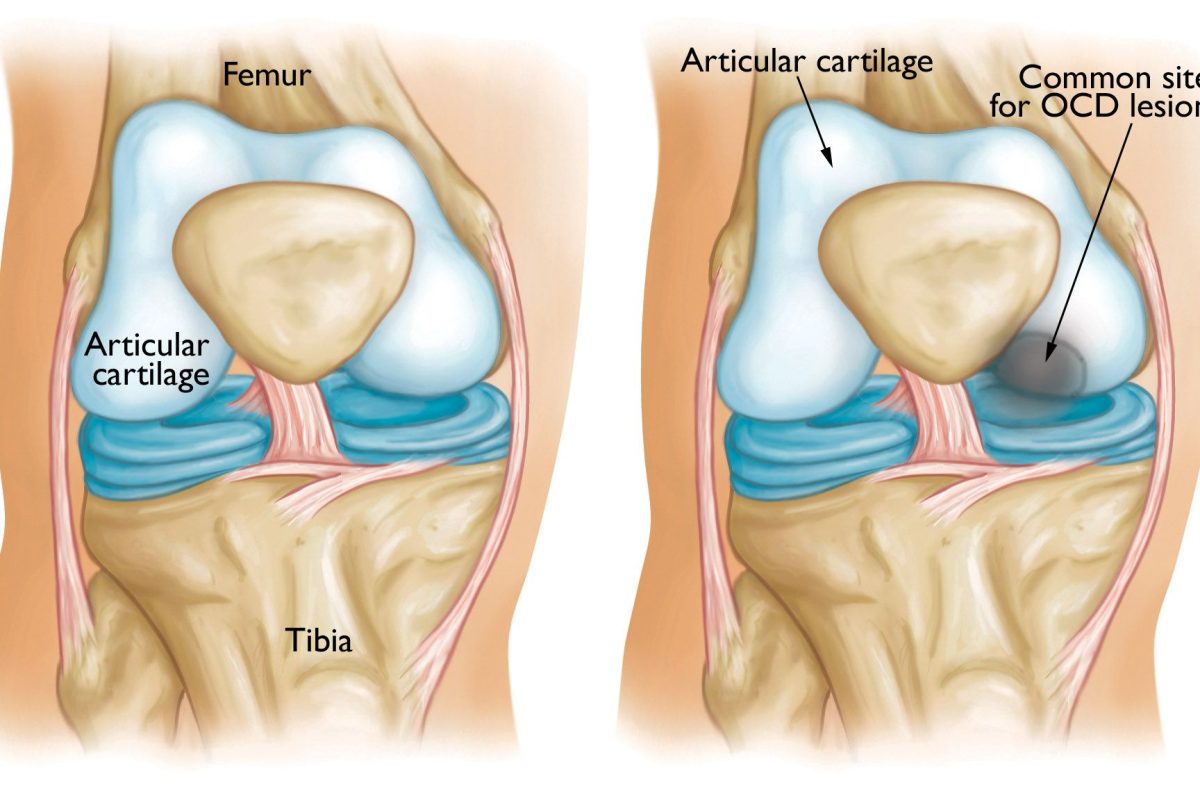 osteocondrita disecanta