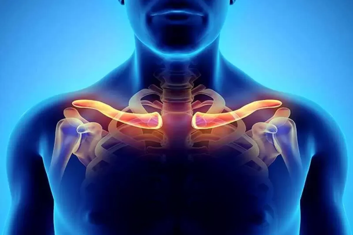 fractura de clavicula